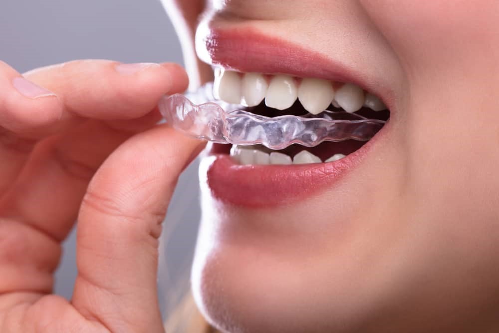 What Is The Minimum Cost Of Braces Enroll Blog   432432423 